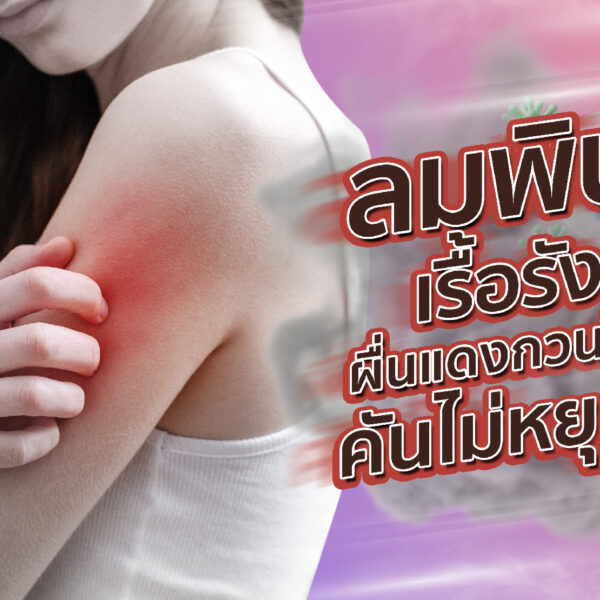 ลมพิษเรื้อรัง ผื่นแดงกวนใจ คันไม่หยุด!
